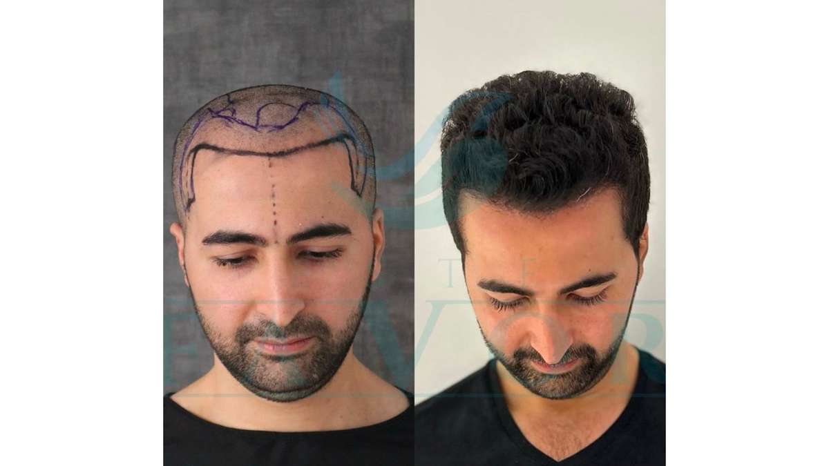 Das beste Haartransplantationszentrum in der Türkei
