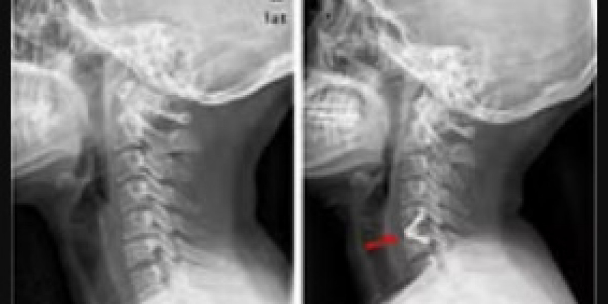 Spine Surgery Freehold NJ